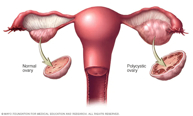 Polycystic ovary